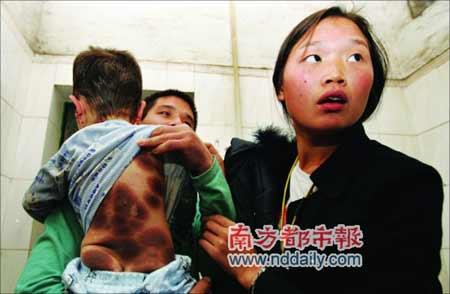 幼童患罕见疾病长满黑斑(图)