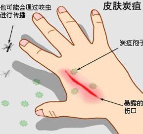 辽宁炭疽疫情