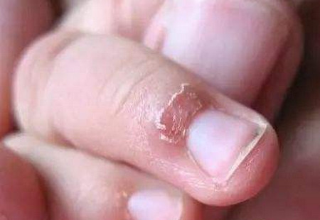 宝宝手上有倒刺真的是缺乏维生素吗？