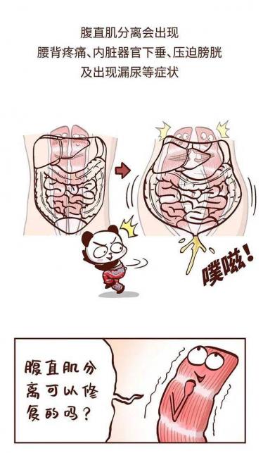 腹直肌分离怎么恢复训练 不练可能会被认为怀孕哦