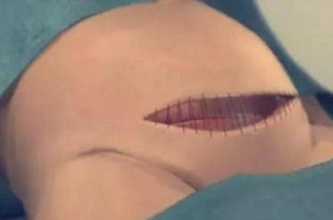 7张图揭露产妇“剖腹产”全过程，男人都该看，网友：母爱太伟大
